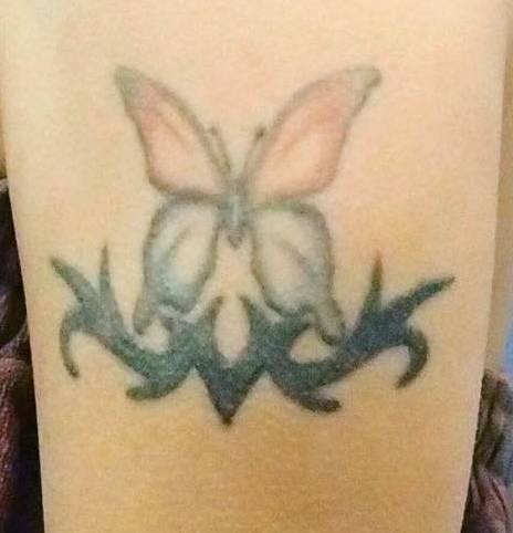 ガーデンクリニック 池袋院でタトゥー（刺青）除去：ピコレーザー治療を受けたZさんの写真