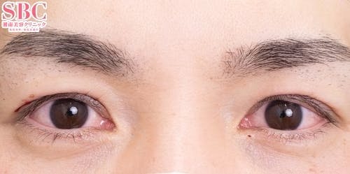 【40代男性・目元】眼瞼下垂＋二重_justafter