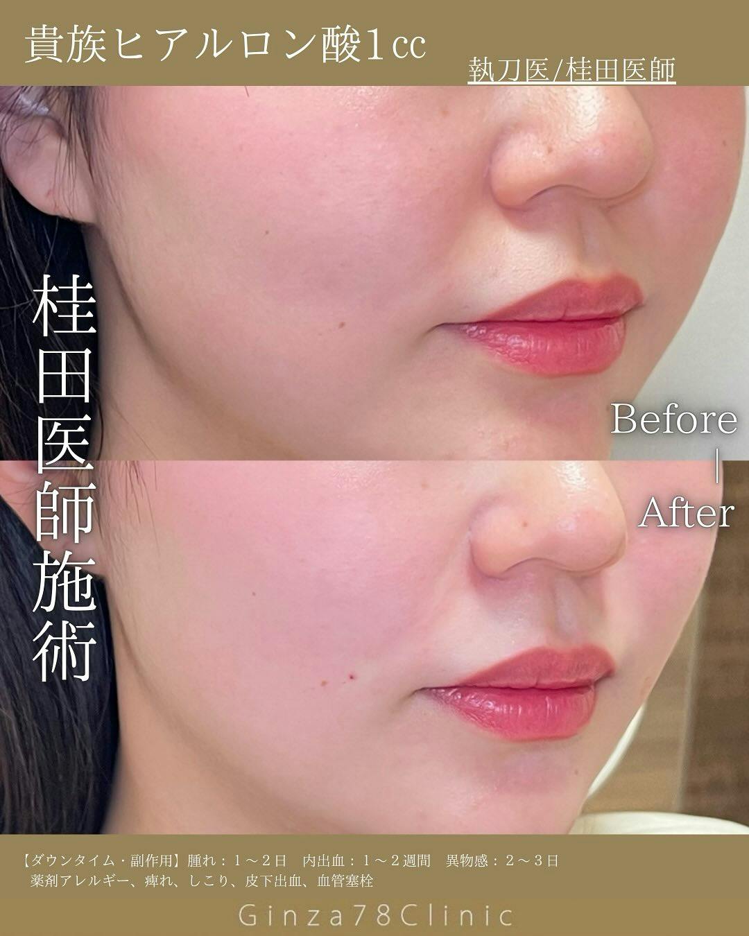 【女性・ほうれい線】ヒアルロン酸_before_aftar