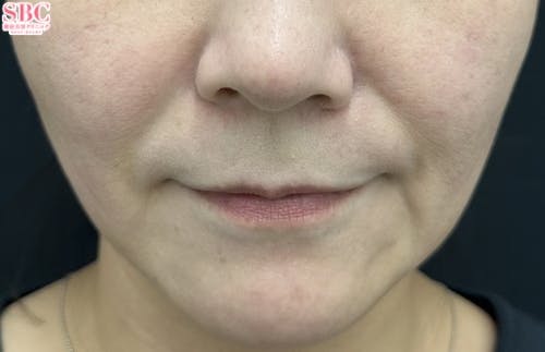 【40代女性・たるみ】ヒアルロン酸ジュビダームビスタ バイクロスシリーズ・VOV（ボブ）リフト・シークレットリフト_1week