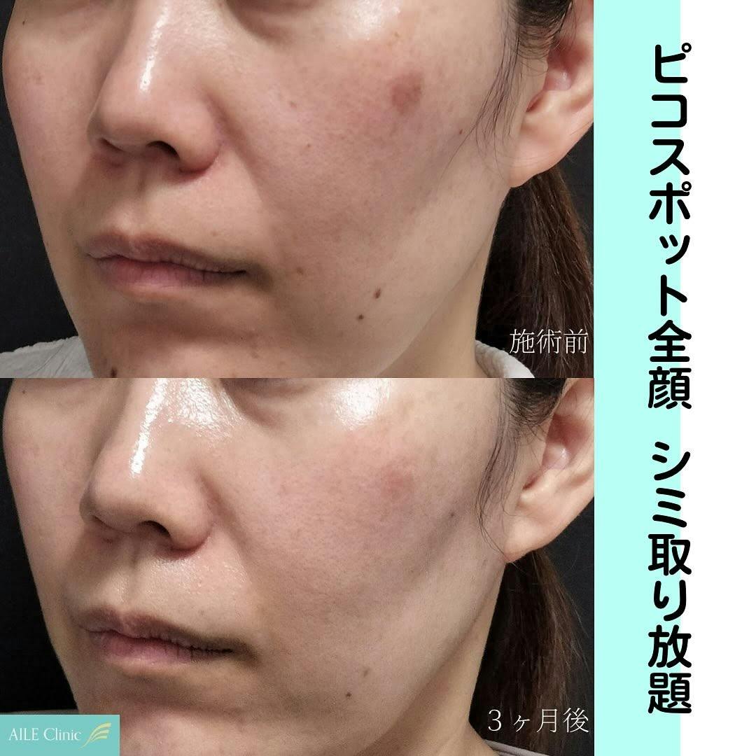 【女性・シミ】ピコスポット全顔_before_aftar
