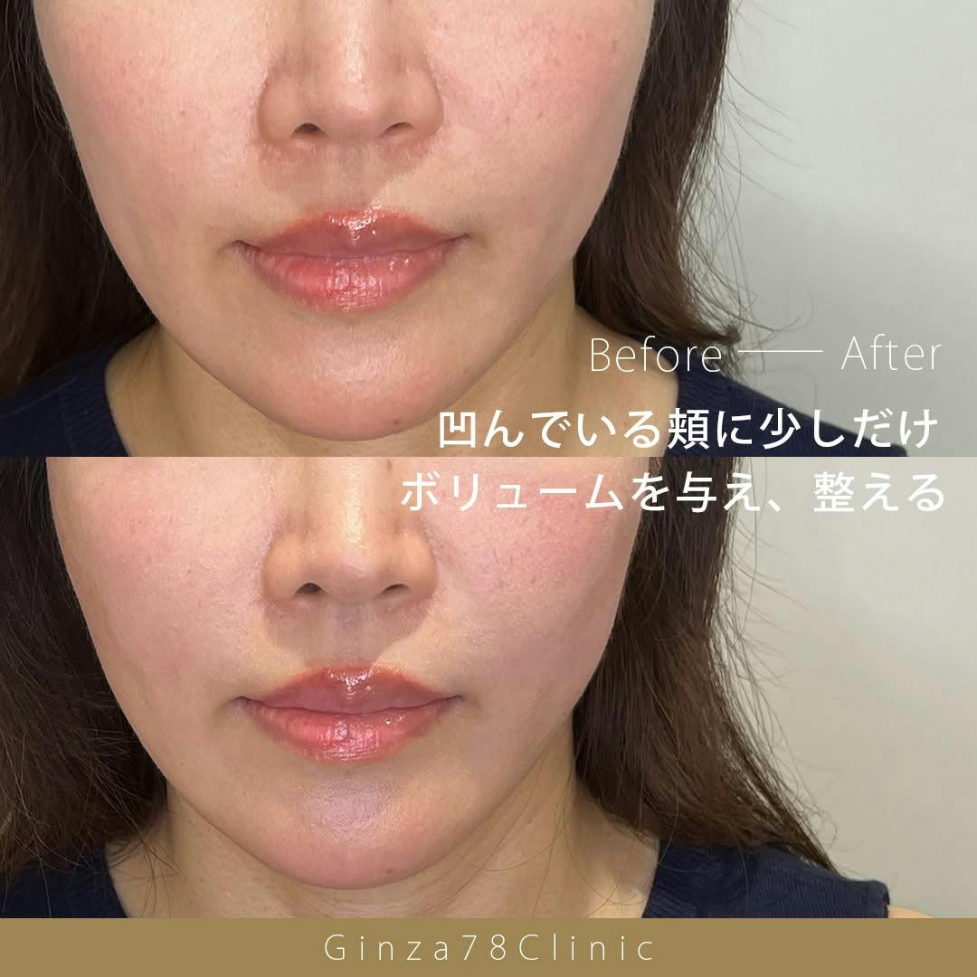 ヒアルロン酸注射・注入・ニューラミスの症例写真・ビフォーアフター