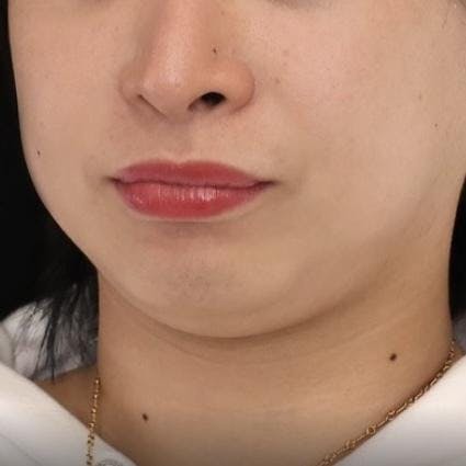 水の森美容クリニック 東京新宿院でエラボトックスを受けたなっちゃんさんの写真