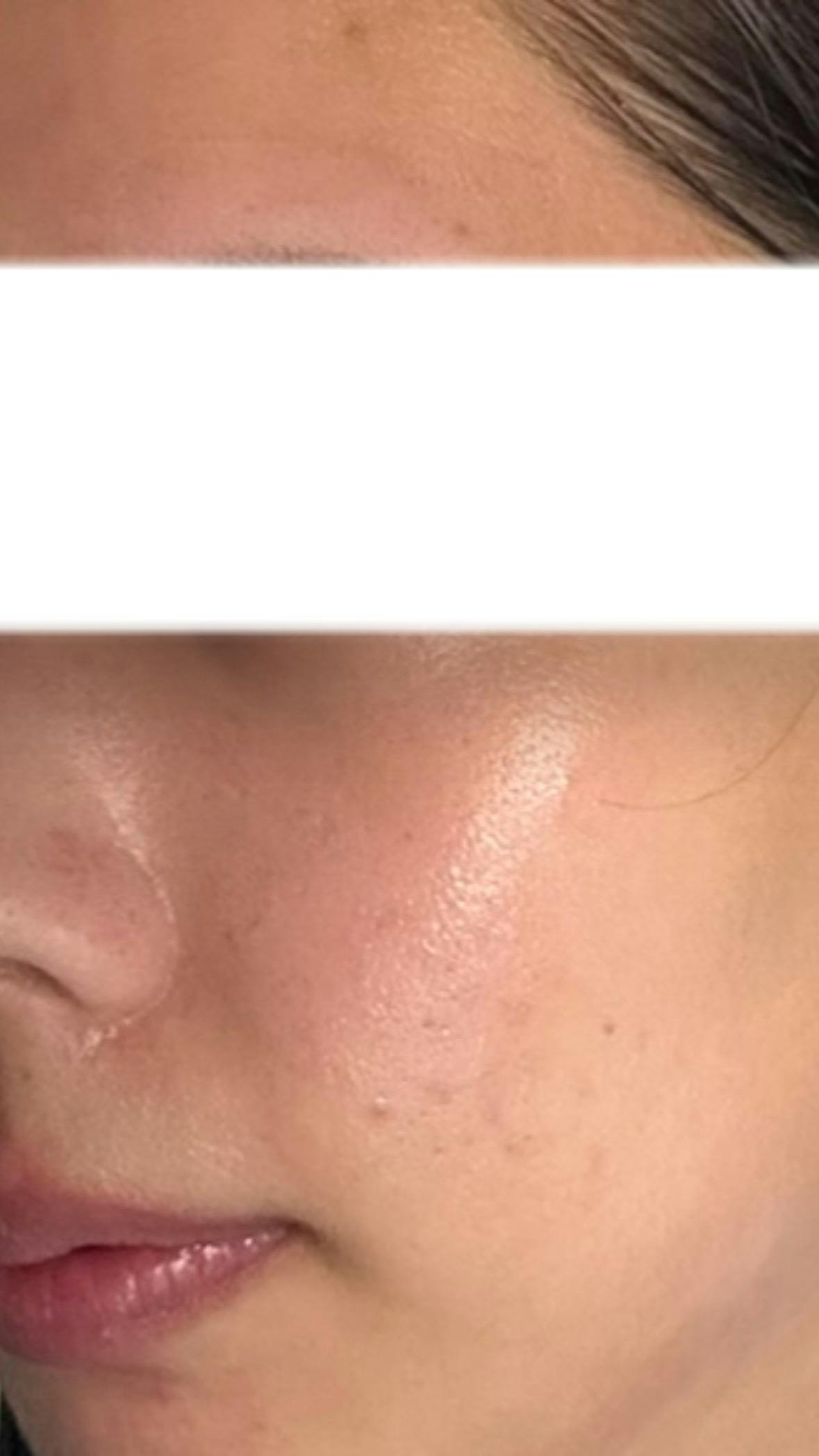 神戸ゆりクリニックでダーマペン4を受けたnurseさんの写真