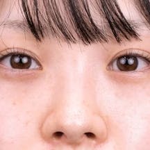 【20代女性・目元】ナチュラル脂肪注射コンデンスリッチ、目の下の切らないクマ・たるみ(ふくらみ)取り_after