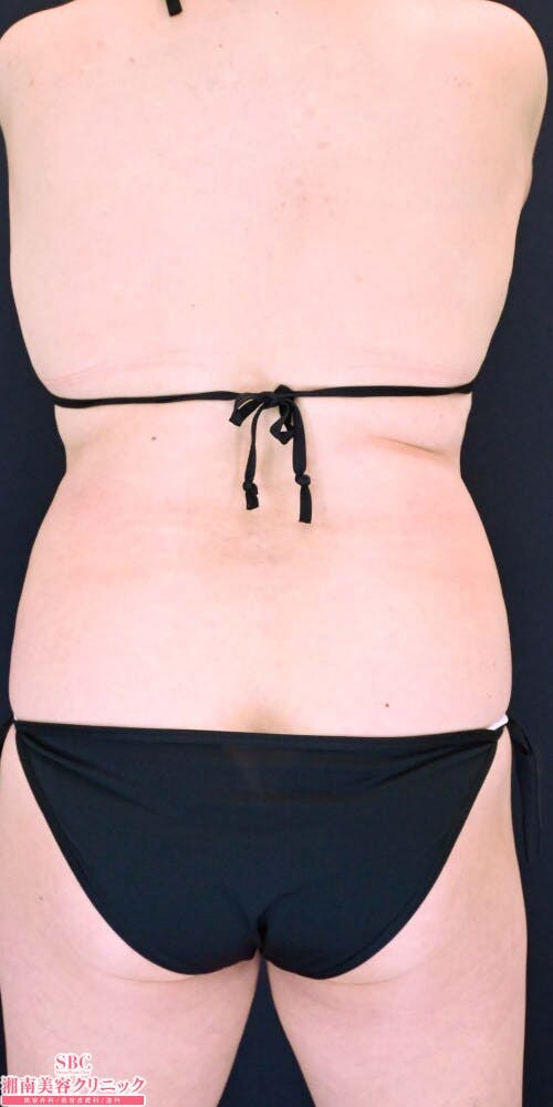 【50代女性・腹部】トゥルースカルプiD サクセンダ_before