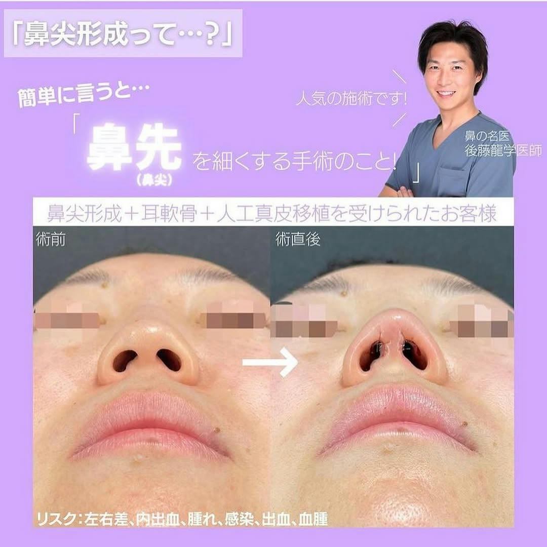 【女性・鼻】4D鼻尖形成_before_aftar