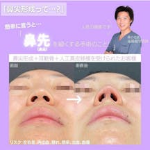 【女性・鼻】4D鼻尖形成_before_aftar