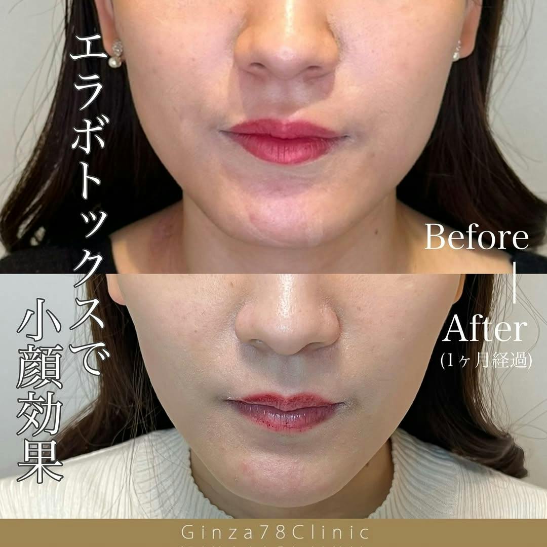 【女性・小顔】ボトックス(韓国製)_before_aftar
