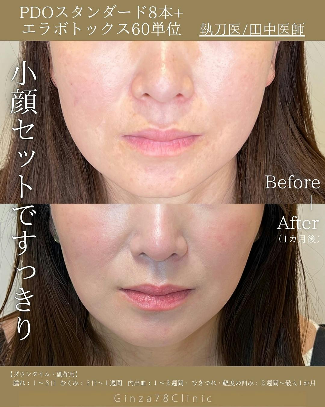 ボトックス注射 えら】Ginza78Clinic(銀座セブンエイト