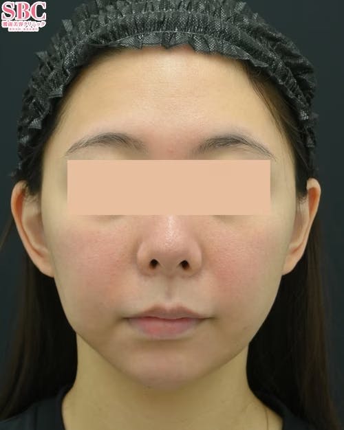 【女性・口元】切らない人中短縮_1week