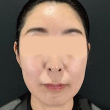 【女性・顔】シークレットリフト、VOV(ボブ)リフト、ヒアルロン酸ジュビダームビスタ バイクロスシリーズ_before