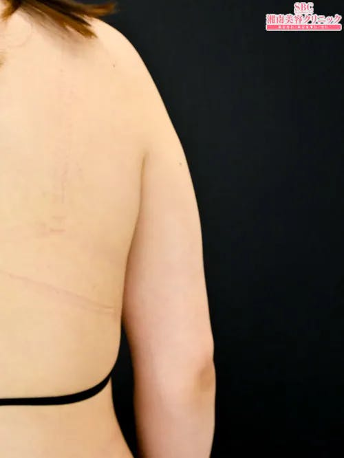 【20代女性・二の腕】クールスカルプティング(R)・ エリート（クルスカダブル） サクセンダ_after