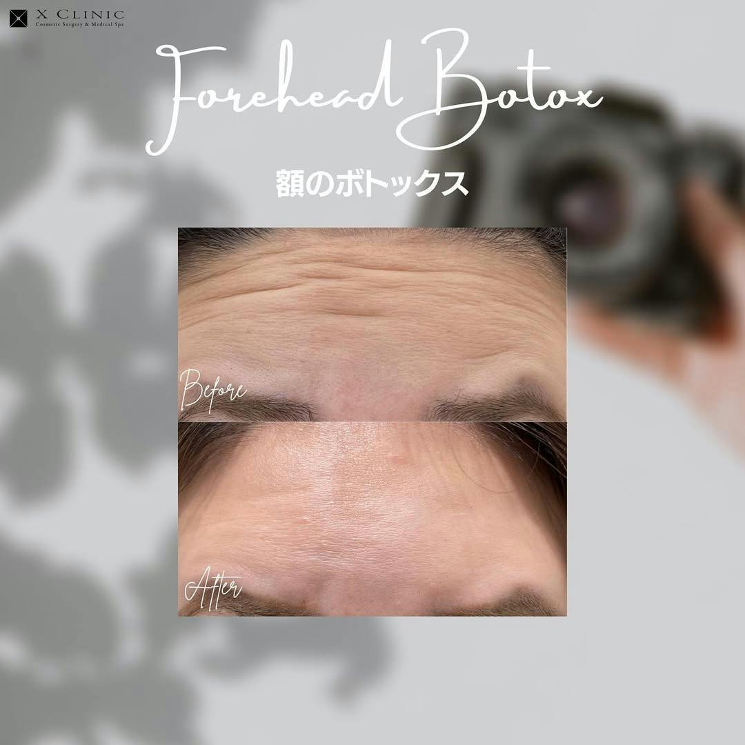 【女性・額】額ボトックス_before_aftar
