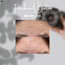 【女性・額】額ボトックス_before_aftar