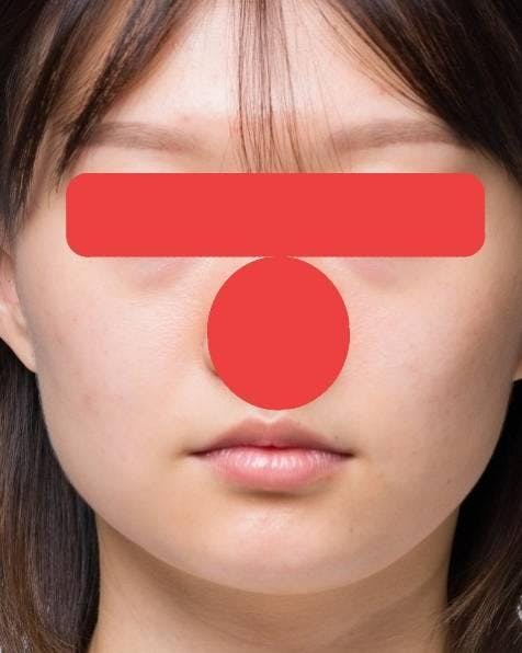 銀座フェイスクリニックで輪郭3点手術：頬骨削り+オトガイ削り+エラ外板削りを受けた０ちゃんさんの写真