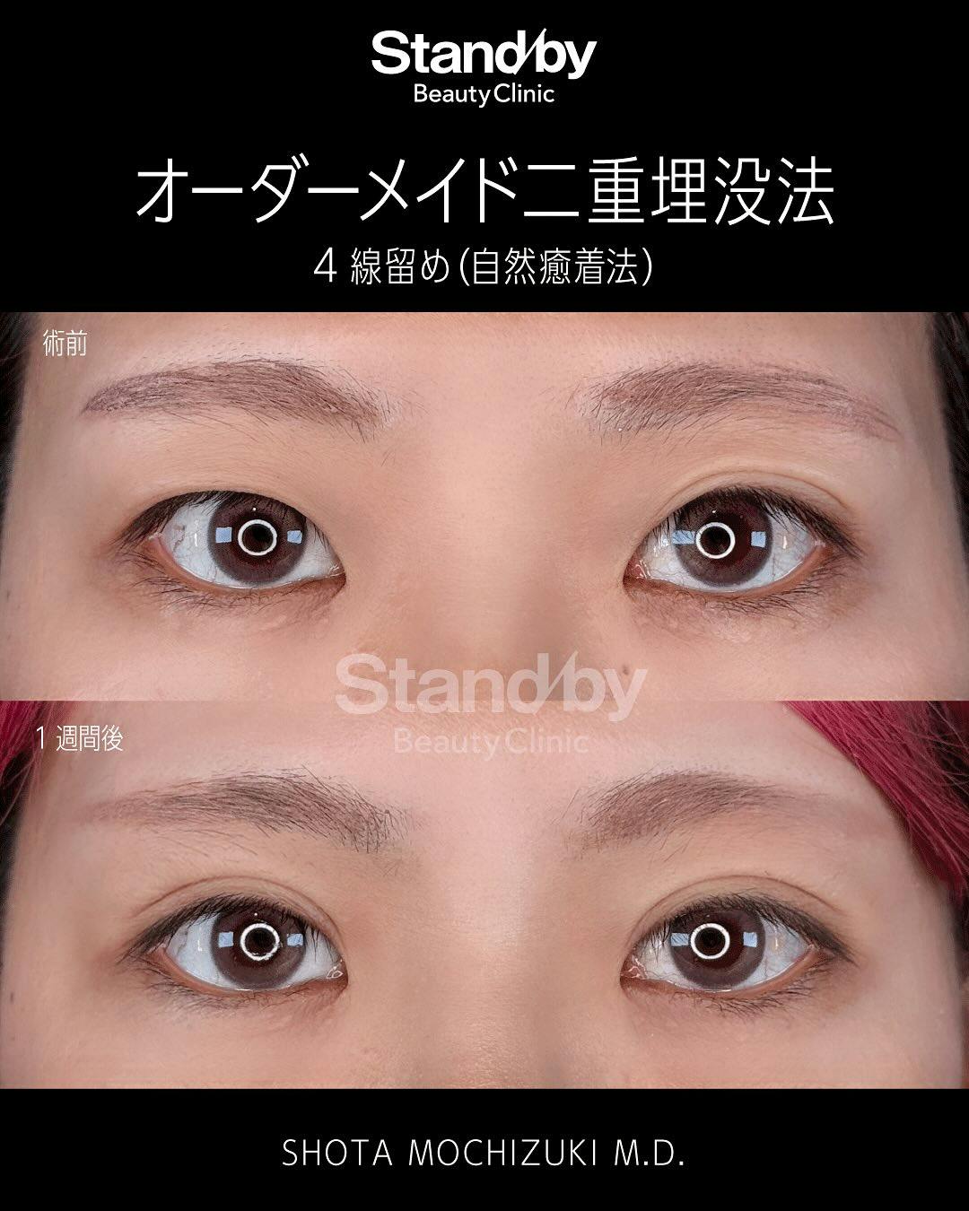 【女性・目元】オーダーメイド二重埋没法　4線留め(自然癒着法)_before_aftar