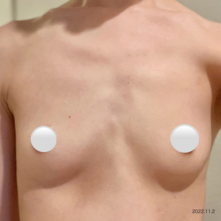 メットビューティークリニック(MET BEAUTY CLINIC)でMET式コンデンス豊胸を受けたarai03さんの写真