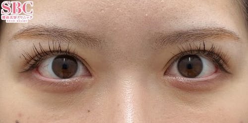 【女性・目元】タルミ取り併用全切開法二重 目頭切開プレミアム 目尻切開法_aftar