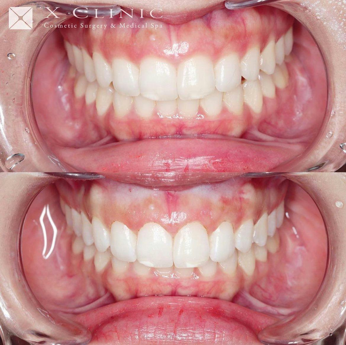 【歯茎】歯肉整形術_before_aftar