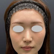 【20代女性・鼻】鼻尖部軟骨移植 鼻尖形成/鼻尖形成3D法(だんご鼻解消術)_after