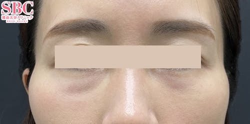 【女性・こめかみ】ヒアルロン酸ジュビダームビスタ バイクロスシリーズ_before