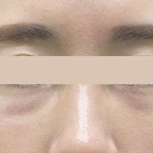 【女性・こめかみ】ヒアルロン酸ジュビダームビスタ バイクロスシリーズ_before