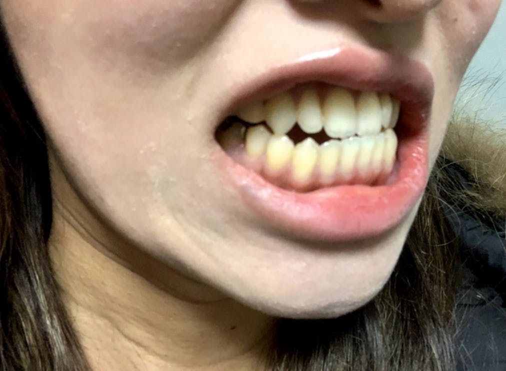 カトレア歯科・美容クリニックでセットバック下顎、オトガイ骨広範囲コッキリ術を受けたこりんさんの写真