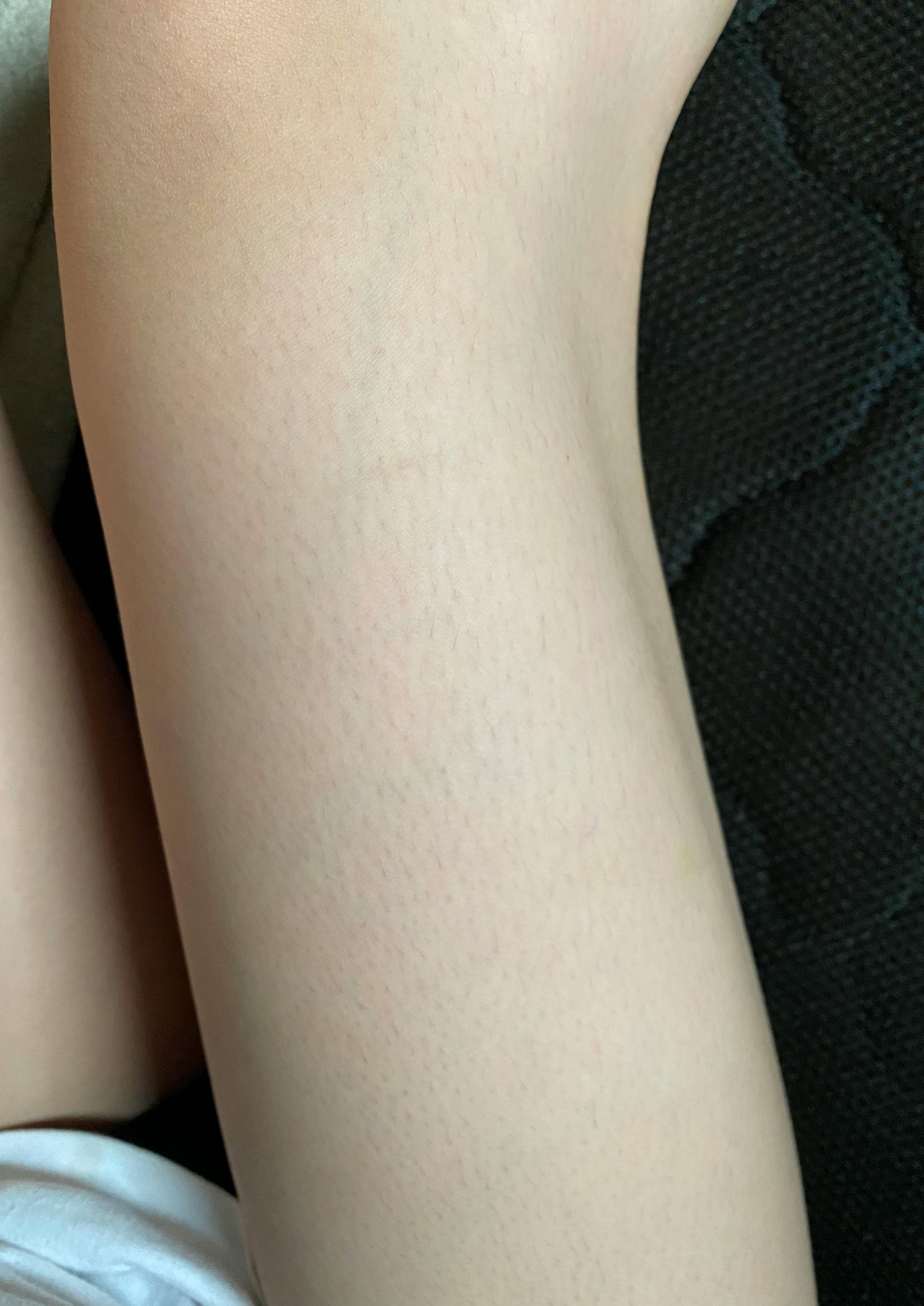 湘南美容クリニック 名古屋院で医療脱毛・胸の医療脱毛・お尻の医療脱毛・腹の医療脱毛・背中の医療脱毛・膝下の医療脱毛・肘下の医療脱毛・太もも・膝上の医療脱毛・肘上の医療脱毛を受けたあいさんの写真