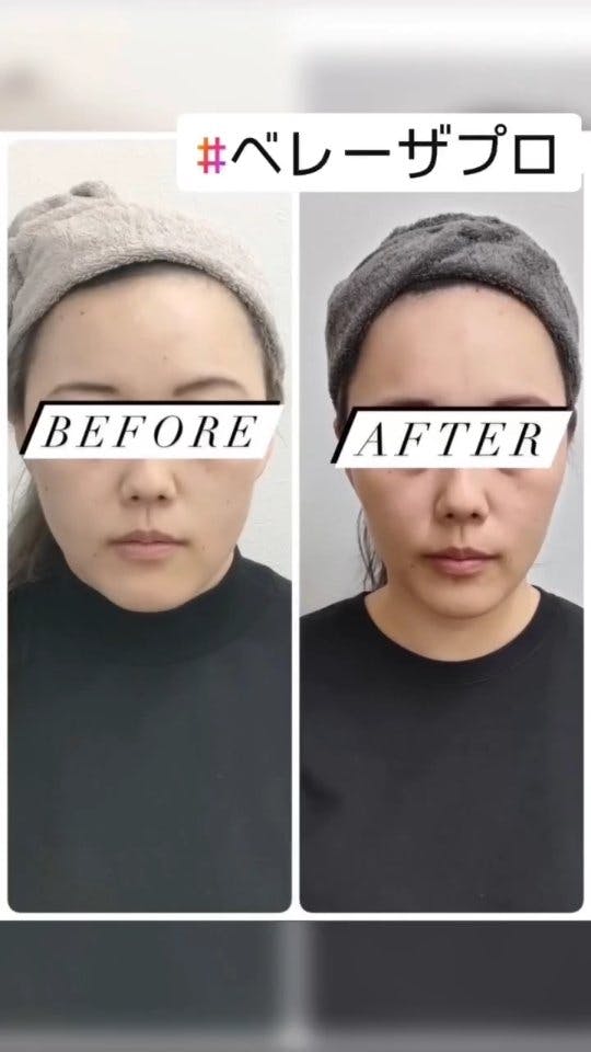 【女性・たるみ】ベレーザプロ_before_aftar
