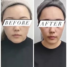 【女性・たるみ】ベレーザプロ_before_aftar