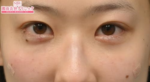 【20代女性・目元】目の下の切らないクマ・たるみ（ふくらみ）取り ナチュラル脂肪注射コンデンスリッチ ナチュラル脂肪注射ナノリッチ_after