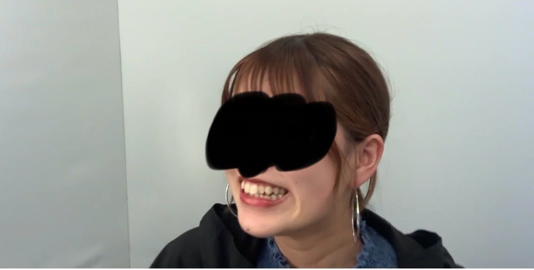 TCB東京中央美容外科 鹿児島院でエラボトックスを受けたきよさんさんの写真