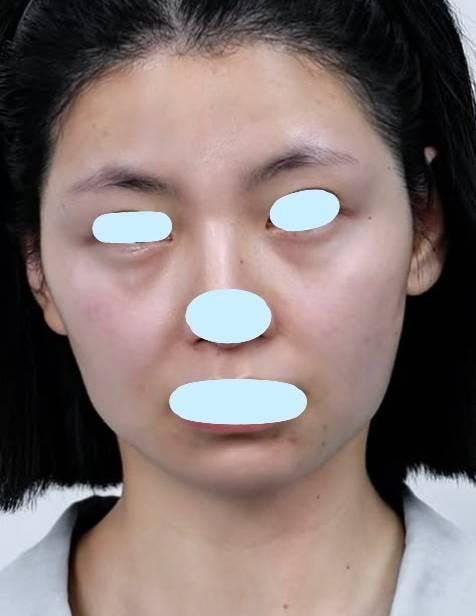 アーモンドクリニック(ALMOND CLINIC)で切らない目の下のクマ・たるみ取り：切らない目の下のクマ・たるみ取りを受けたsakiさんの写真