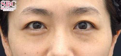 【女性・目元】裏ハムラ法、ナチュラル脂肪注射ナノリッチ_before