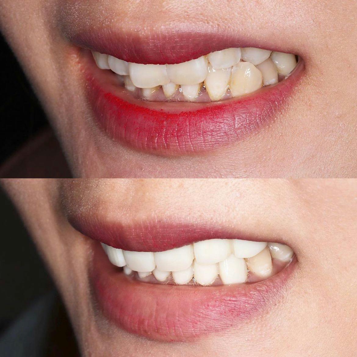 【女性・歯】1dayスピードセラミック 矯正_before_aftar