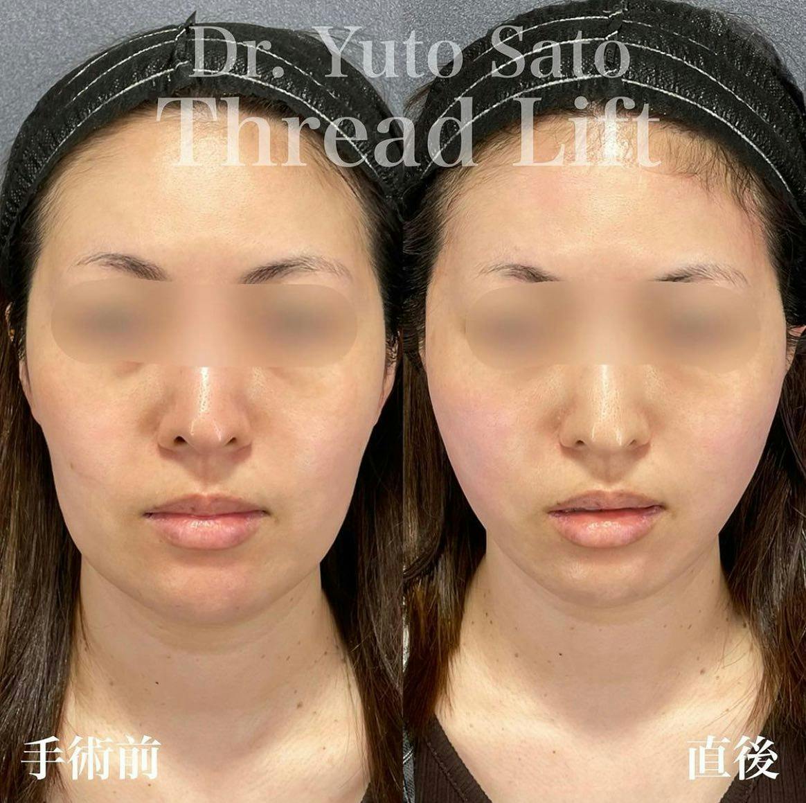 【女性・輪郭】糸リフト ボトックス_before_aftar