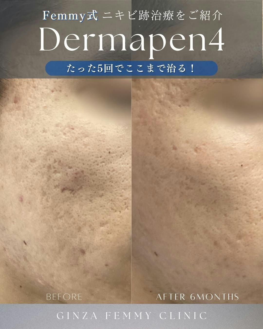 【男性・ニキビ跡】ダーマペン_before_aftar