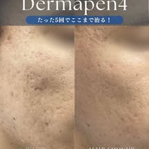 【男性・ニキビ跡】ダーマペン_before_aftar