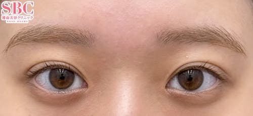 【女性・目元】クイックコスメティーク・ダブルNeo_after