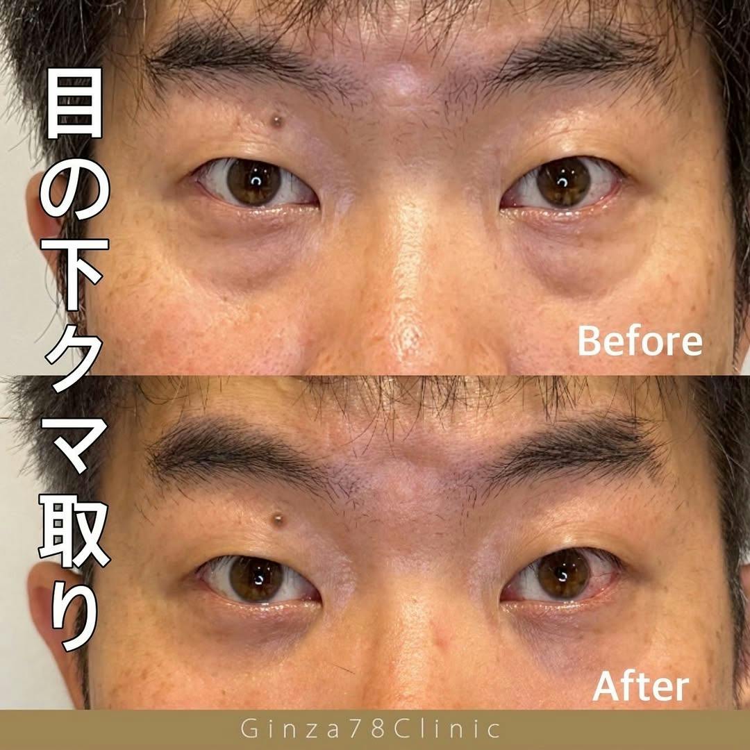 【男性・目元】目の下のクマ取り_before_aftar