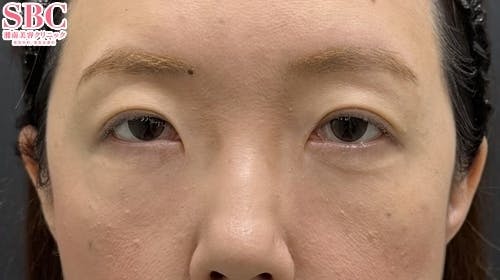 【40代女性・目元】目の下の切らないクマ・たるみ（ふくらみ）取り ナチュラル脂肪注射コンデンスリッチ ナチュラル脂肪注射ナノリッチ_after