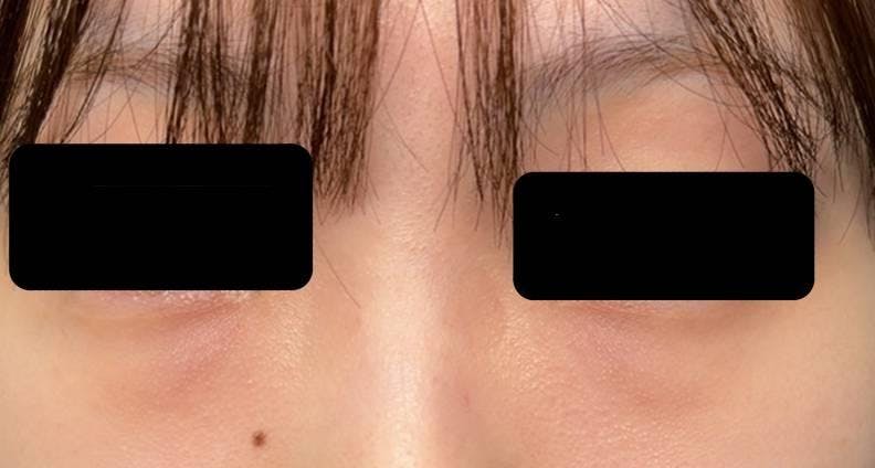 ルラ美容クリニック 渋谷本院で目の下のふくらみ取り：経結膜脱脂術を受けたNONOさんの写真
