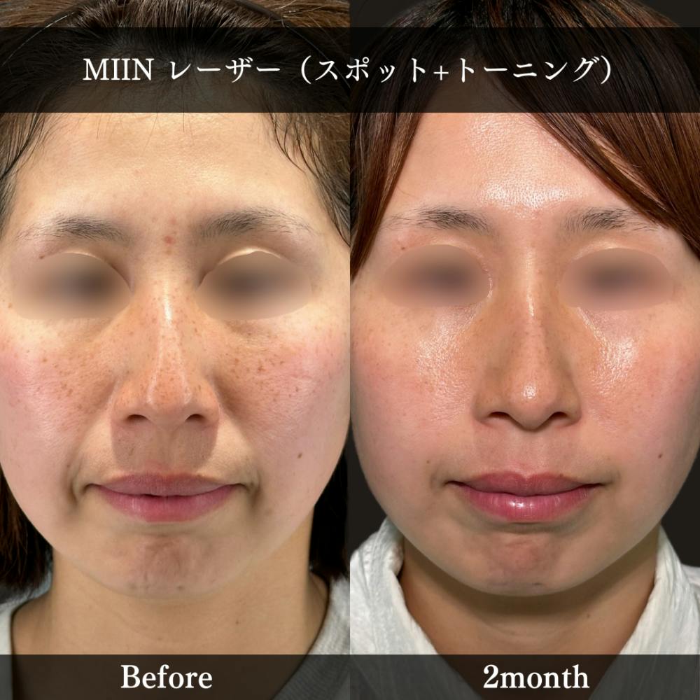 【30代女性・顔】美人レーザー(MIINレーザー) トーニング＋スポット シミ取り放題_before_aftar