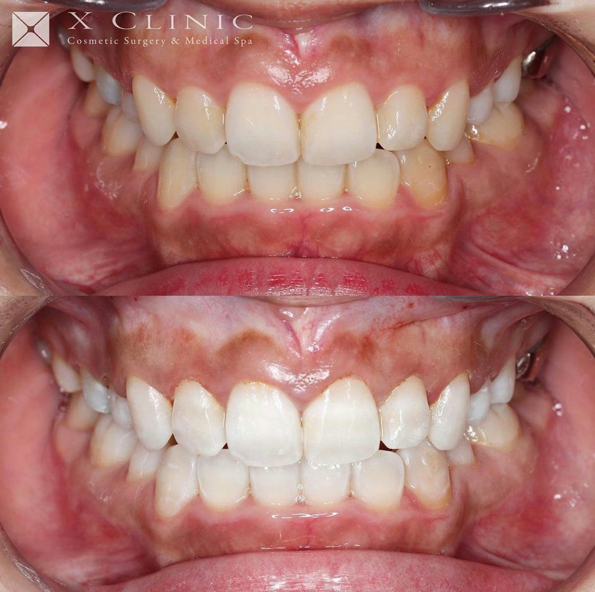 【歯】歯肉整形術 オフィスホワイトニング_before_aftar