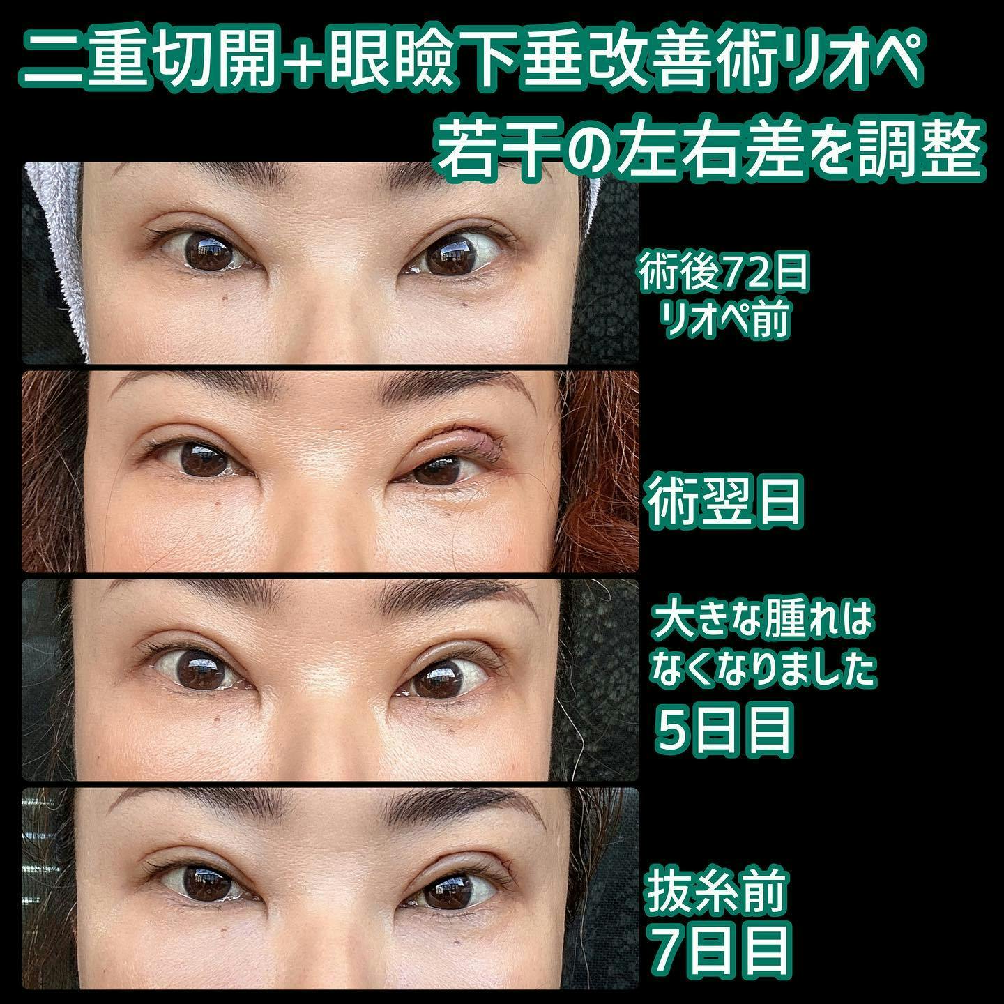 【女性・目元】二重切開＋眼瞼下垂改善術リオペ_before_aftar