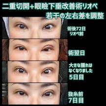 【女性・目元】二重切開+眼瞼下垂改善術リオペ_before_aftar