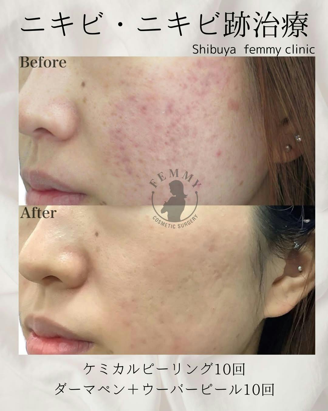 【女性・ニキビ】ケミカルピーリング・ダーマペンウーバーピール_before_aftar
