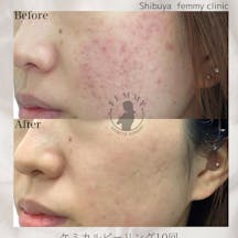 【女性・ニキビ】ケミカルピーリング・ダーマペンウーバーピール_before_aftar
