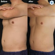 【男性・腹部】クールスカルプティング_before_aftar